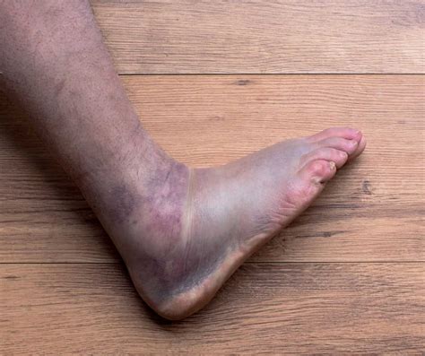 Sprained Ankle Recovery Time explained by an Ankle Specialist