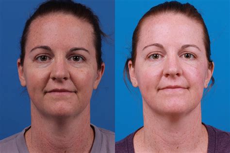 Patient 122406447 | Mohs Surgery and Skin Cancer Before & After Photos | Clevens Face and Body ...