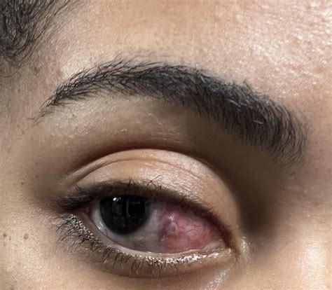 Complications after surgery? : r/Strabismus