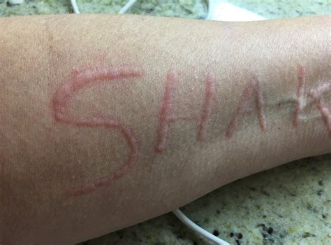 Dermographism: Writing on the skin- Clinical Advisor
