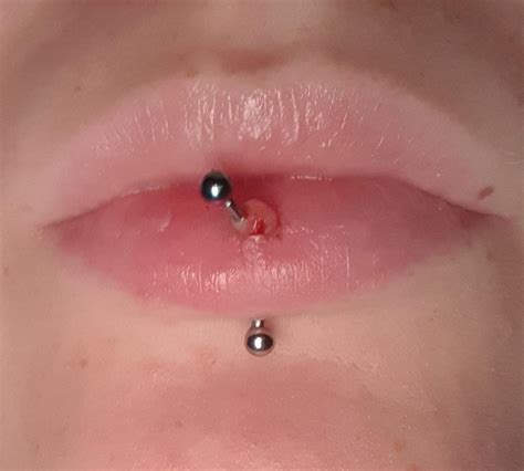 Lip pircing bump I got my vertical labret pircing 6 months ago a bump ...