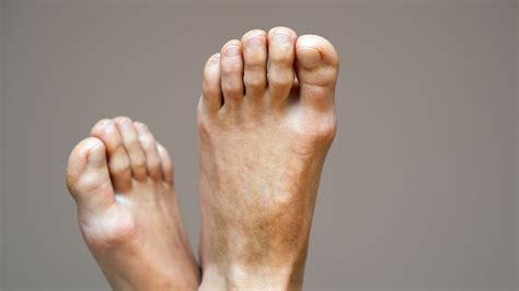 Bunions Corns Calluses