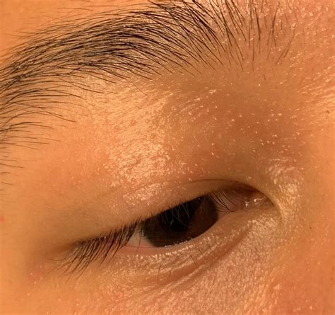 White Bump On Eyelid Causes Treatment Remedies Pictures