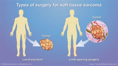Diagnosing and Treating Soft Tissue Sarcoma