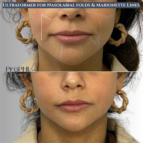 Ultraformer III treatment before & after photos