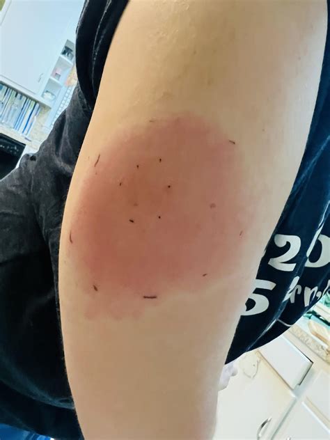 Stung by a wasp on my arm over 48 hours ago. When should I seek medical ...