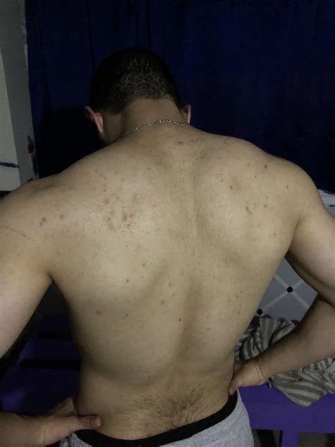 [25M] Any advice on how to get rid of bacne scars? I had bad back acne few years ago that I didn ...