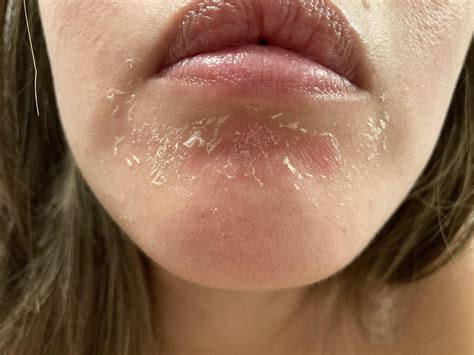 Mouth Is Shedding Skin at Keira Woolley blog