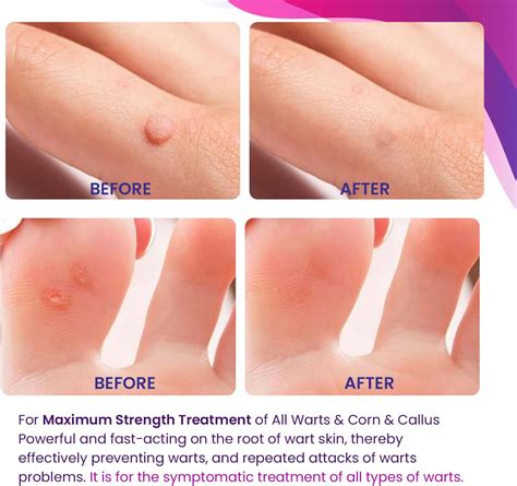 KRONA Gel líquido de acción rápida de máxima resistencia, removedor de verrugas, removedor de ...