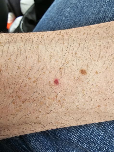 Blood spot on arm, should I be concerned? : r/medical_advice
