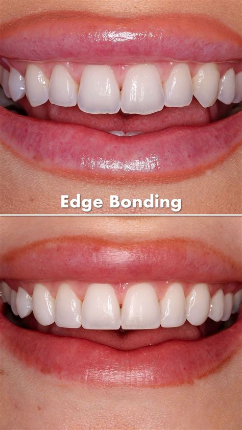 Teeth Bonding Kilkenny at Alan Schull blog