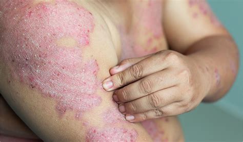 How Do You Cure Eczema