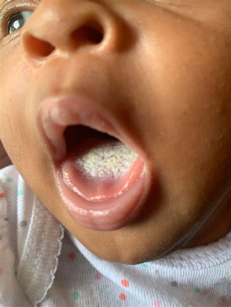 Thrush Tongue Baby