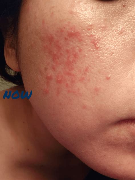 Small, red bumps in face that get worst with sun exposure. What to do? : r/30PlusSkinCare