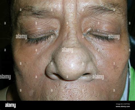 Face of a Hispanic female patient with mixed connective tissue disease (MCTD). MCTD is a rare ...