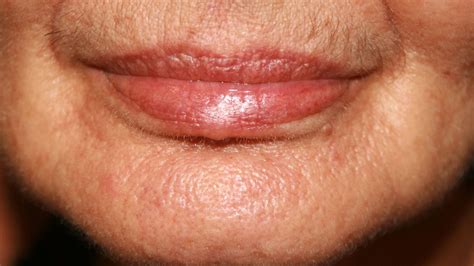 Wrinkles Around Mouth