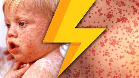 Lightning Learning: Rubella (aka German Measles) — EM3
