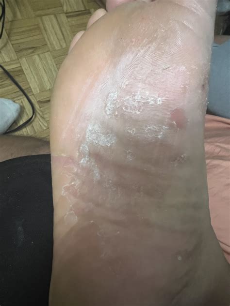 Cause Of Itchy Palms And Feet at Eileen Crofts blog