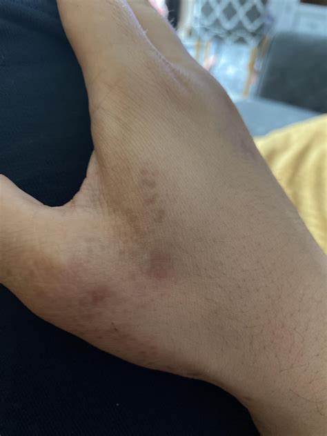 White Spots On Skin Lovetoknow White Spots On Tattoo Second Skin?