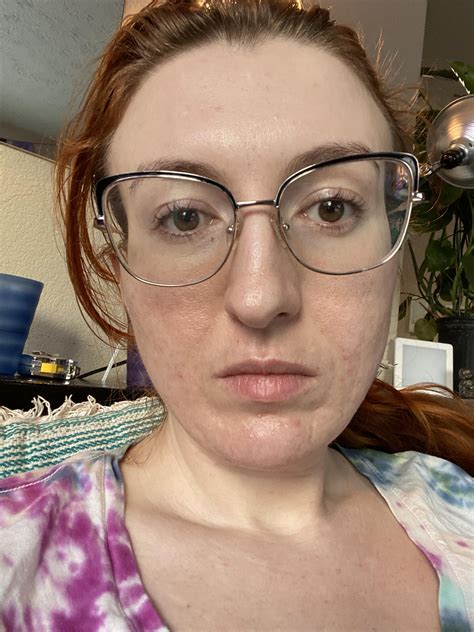 Best procedure to fix my smile, sleep, & dimple wrinkles primarily on the left side of my face ...