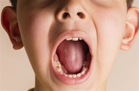 Can Tooth Decay Be Reversed? | Unionville