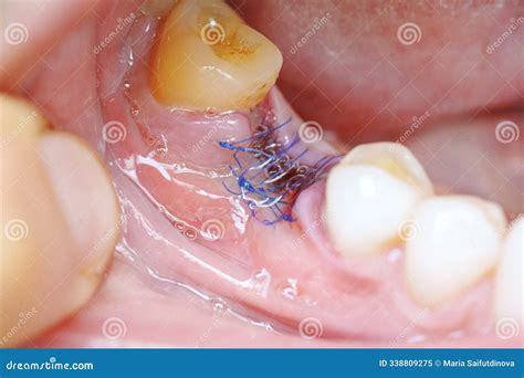 Closeup Of A Sutured Incision On A Young Dog`s Lower Abdomen A Day ...