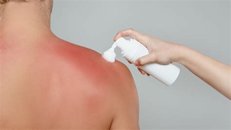 How to Treat a Sunburn | GentleCure