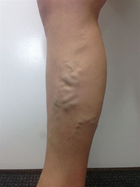 Deep Varicose Veins Treatment at Alan Darlington blog