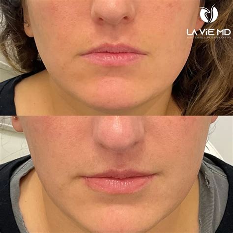 Masseter Botox Gone Wrong? Jowls, Risks & Prevention
