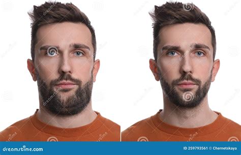 Double Chin Problem. Collage with Photos of Man before and after Plastic Surgery Procedure on ...