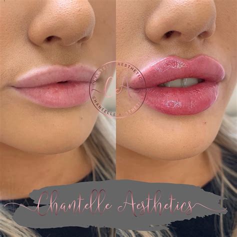 Chantelle Aesthetics on Instagram: “Throwback to these first time lips ...