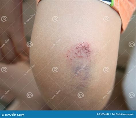 Bruise on knee stock photo. Image of health, healing - 29234044