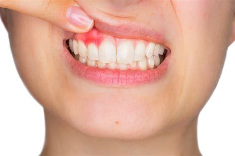 Bleeding Gums Treatment: What Should Patients Know? 1