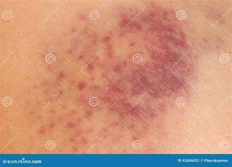 Itchy Rash Bruises Legs at Charles Banks blog
