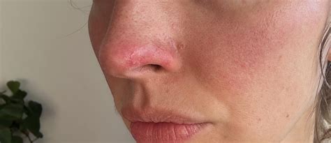 Seeking advice for how to manage rosacea nose flare ups. : r/Rosacea
