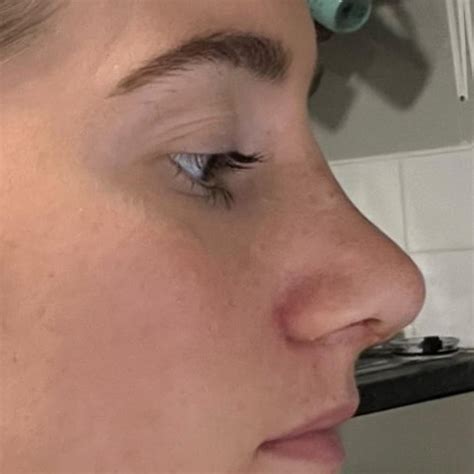 Septorhinoplasty | Deviated Septum | Pall Mall