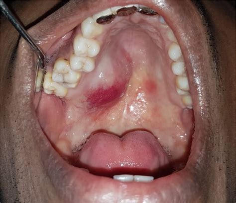 An extensive nodular lesion involving hard palate and nasal turbinate - Oral Surgery, Oral ...