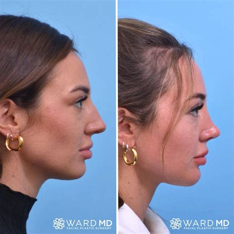 Pin by Claudia Sarai Rangel on Guardado rápido | Nose job, Rhinoplasty nose jobs, Facial fillers
