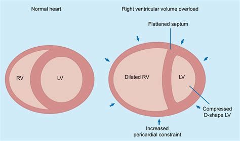 Contemporary management of acute right ventricular failure: a statement from the Heart Failure ...