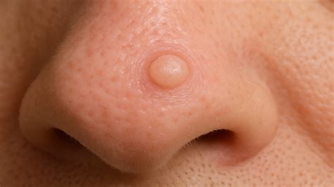 Fibrous Papules: Causes & Treatments Explained