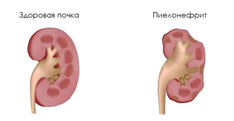 Пиелонефрит - лечение у ведущих врачей • Русский Доктор