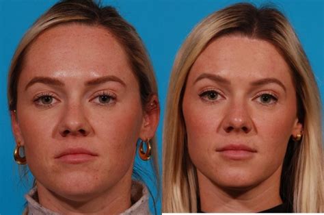 Hairline Advancement Before & After Photos Patient 171 | Tucson, AZ | Foothills Facial Plastic ...