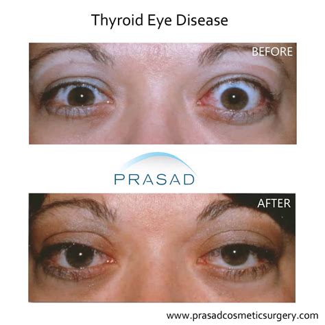 Update On Thyroid Eye Disease