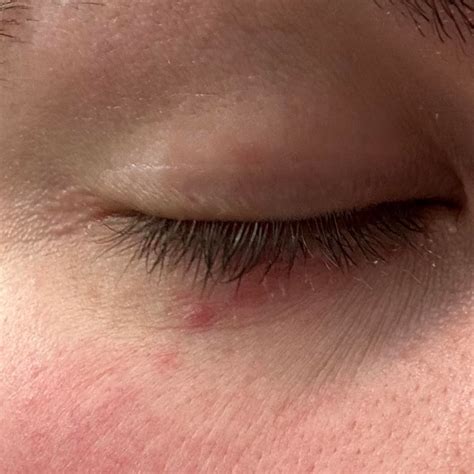 Small red bumps/rash under eye. Has been coming and going for a while ...