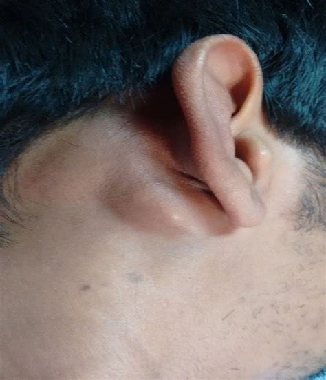 Posterior Auricular Lymph Node