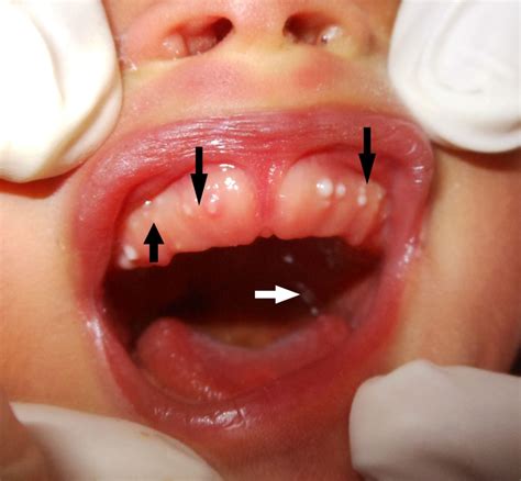 Palatal and Gingival Cysts of the Newborn | Treatment & Management ...