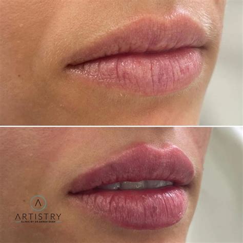 Lip Botox Before And After Botox For Lip Flip Edmonton Dermatology
