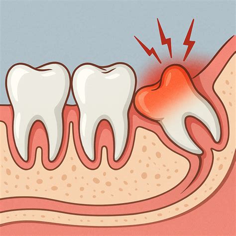 What Does Wisdom Tooth Pain Feel Like? Common Signs Explained - Dental Center of Tysons Corner
