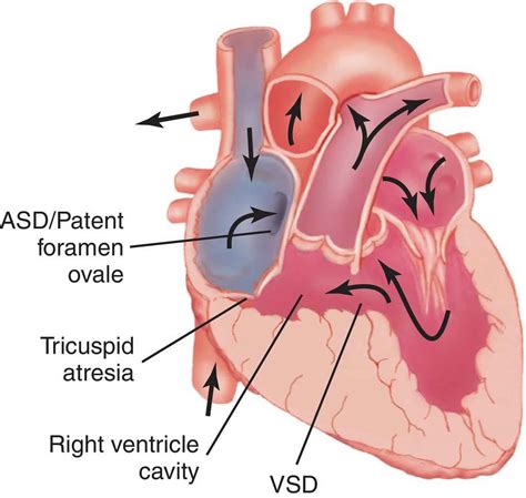 Tricuspid atresia causes, symptoms, diagnosis, treatment & prognosis