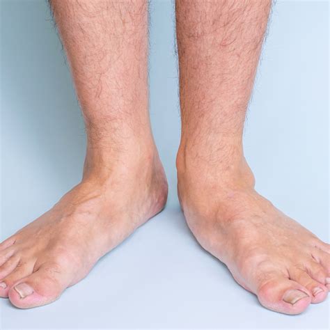 Flat Feet – GMC Podiatry